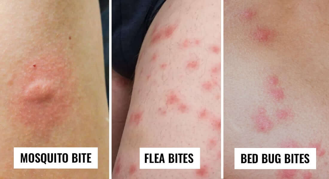Diferent from Bed Bugs Bites 
